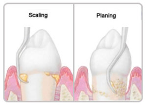 dental scaling