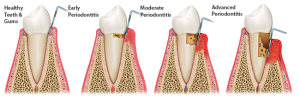 Behaviors that Induce Gum Disease