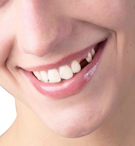 What Induces Missing Teeth & How to Prevent It