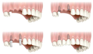 Combat Missing Tooth Problems thru Dental Implants