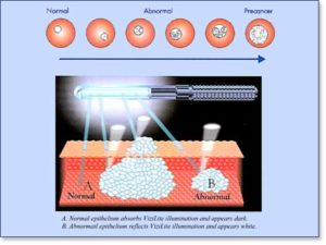 overcome-mouth-cancer-threats-using-vizilite-plus