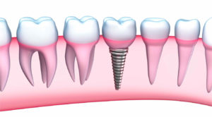 dental-implants-you-2