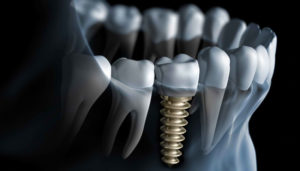 dental-implants-you